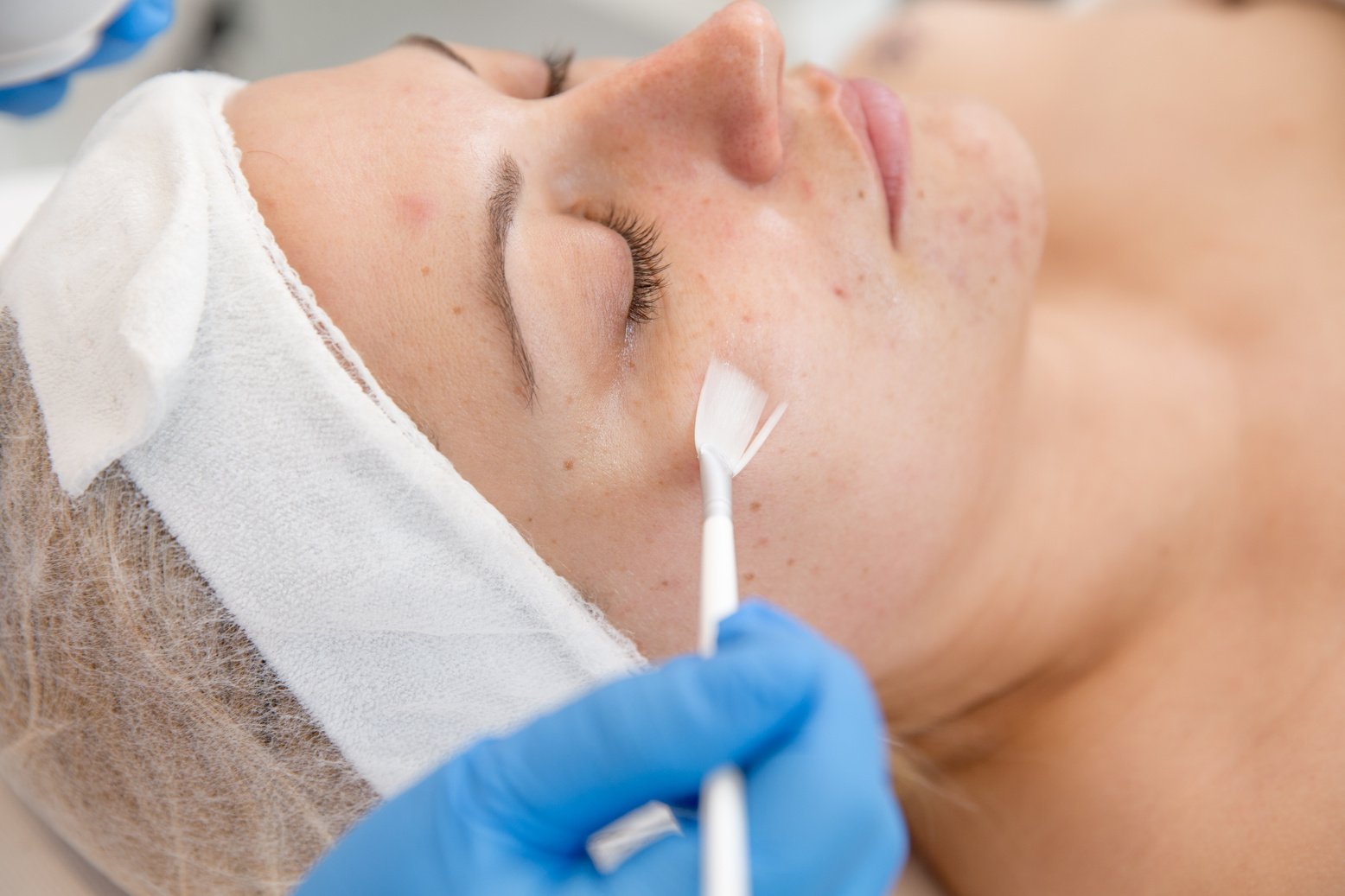 Adult Woman Receiving Skin Chemical Peel Treatment at Dermatologist